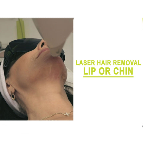 Laser Hair Removal Lip or Chin 6 Treatments